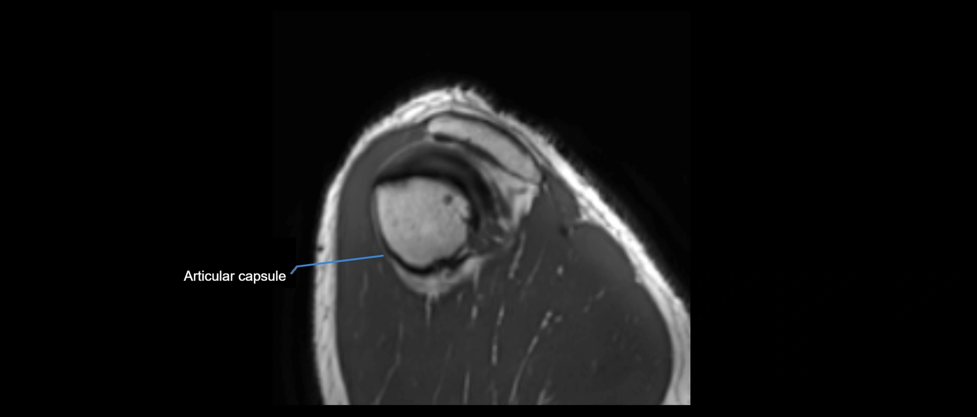 shoulder ligaments sagittal  cross sectional anatomy 3T MRI AI enhanced radiology image -img-00001-00052.webp